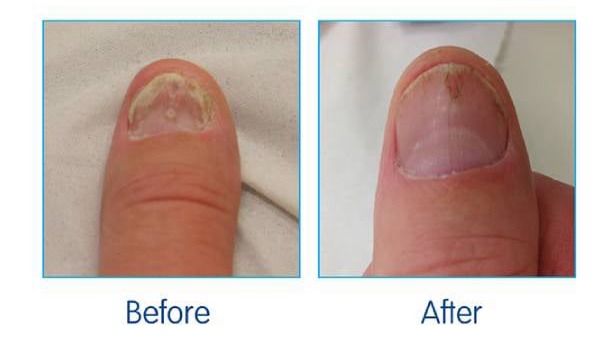 Lumonail Nail Fungus